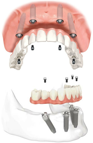 All-on-4 - prothèse haut ou bas - Dentiste Touchette à Gatineau