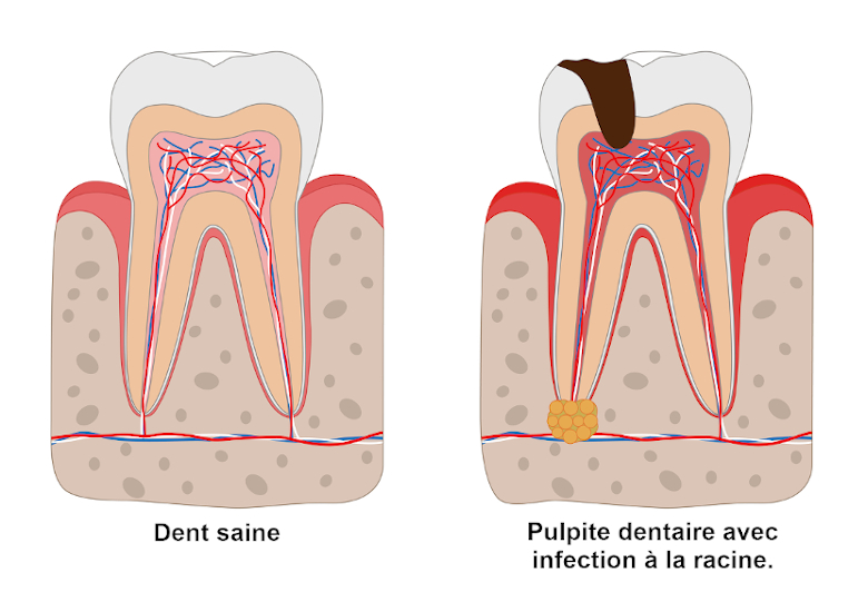 Pulpe dentaire endommagée - Dentistes Touchette de Gatineau 