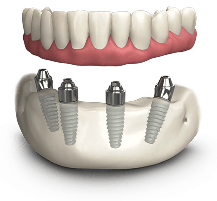 Prothèse fixe sur 4 implants - Dentiste Touchette à Gatineau 
