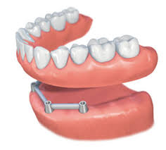 Implants dentaires - prothèse sur barre - Dentiste Touchette à Gatineau